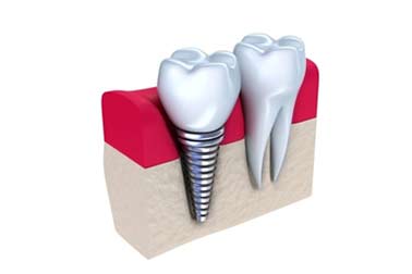 Dental Implants